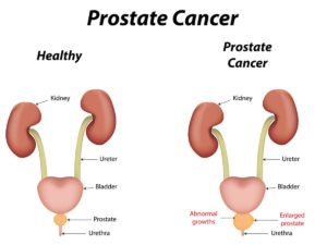 prostatecancer
