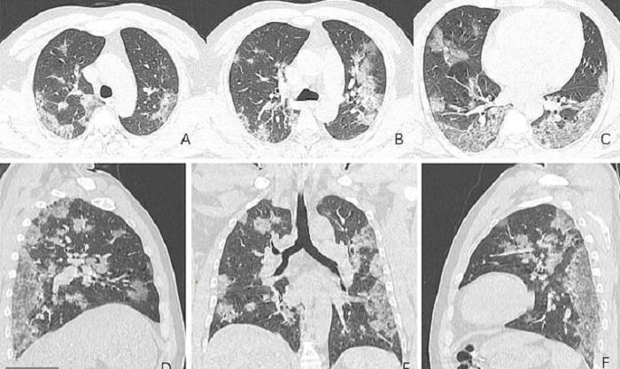 121-191541-x-raycoronavirus-does-victims-lungs-2